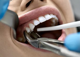 A dentist attempting to extract a patient’s tooth