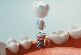 a computer illustration depicting an implant crown