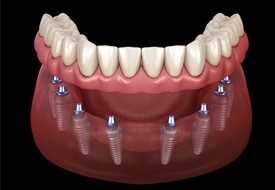 a computer illustration of implant dentures