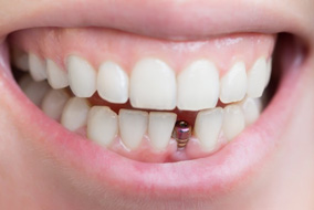 Smile with dental implant