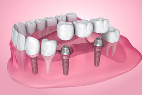 Illustration of dental implants with crown and bridge